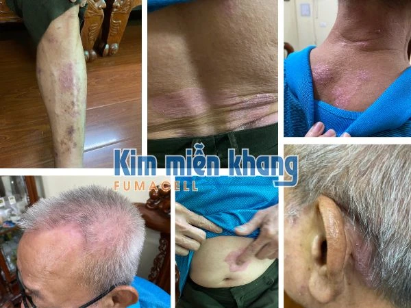 vảy nến 3.jpg