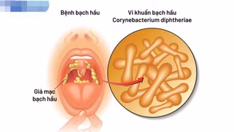 Cần lưu ý điểm gì khi trẻ mắc bệnh bạch hầu