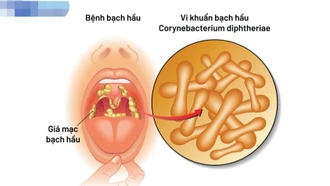 Cần lưu ý điểm gì khi trẻ mắc bệnh bạch hầu