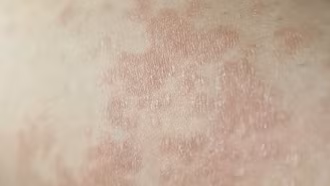 Có gần 50 bệnh da hiếm gặp