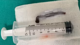  Gắp thành công con vắt dài khoảng 5 cm trong mũi bé 4 tuổi