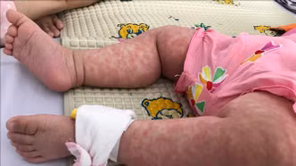 Bệnh sởi đã đến "mùa", chuyên gia hướng dẫn cách chăm sóc, phòng bệnh