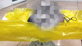 Phẫu thuật thành công khối u nặng hơn 3 kg