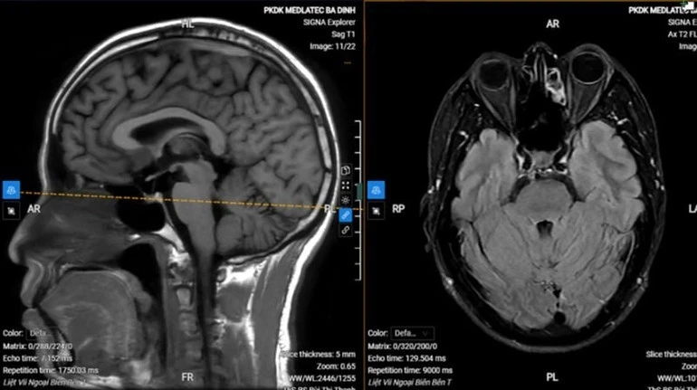 Hình ảnh chụp MRI của bệnh nhân.