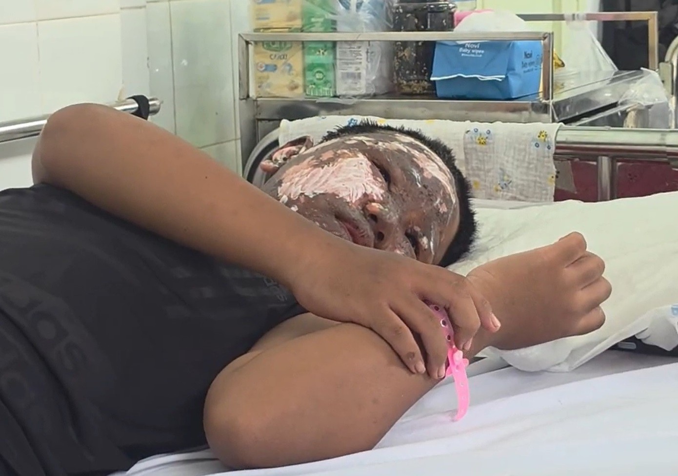 Khuôn mặt bệnh nhi bị cháy đen, bỏng nặng khi chơi pháo nổ bán trái phép trên mạng xã hội.