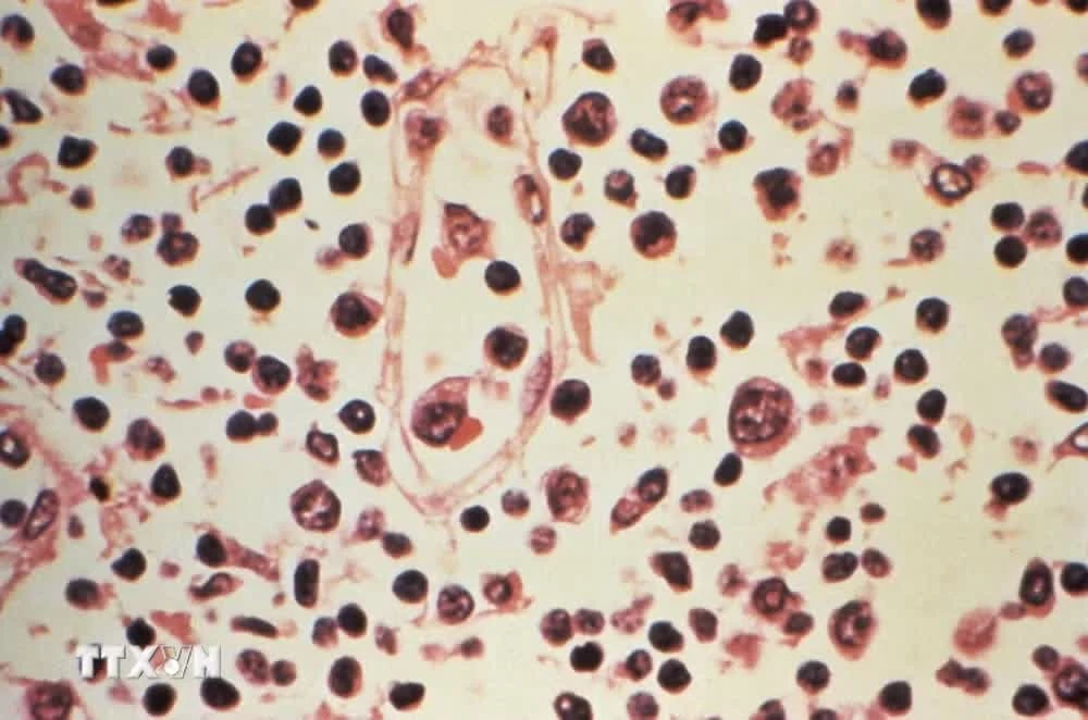 Mẫu bệnh phẩm của một bệnh nhân nhiễm virus Hanta.