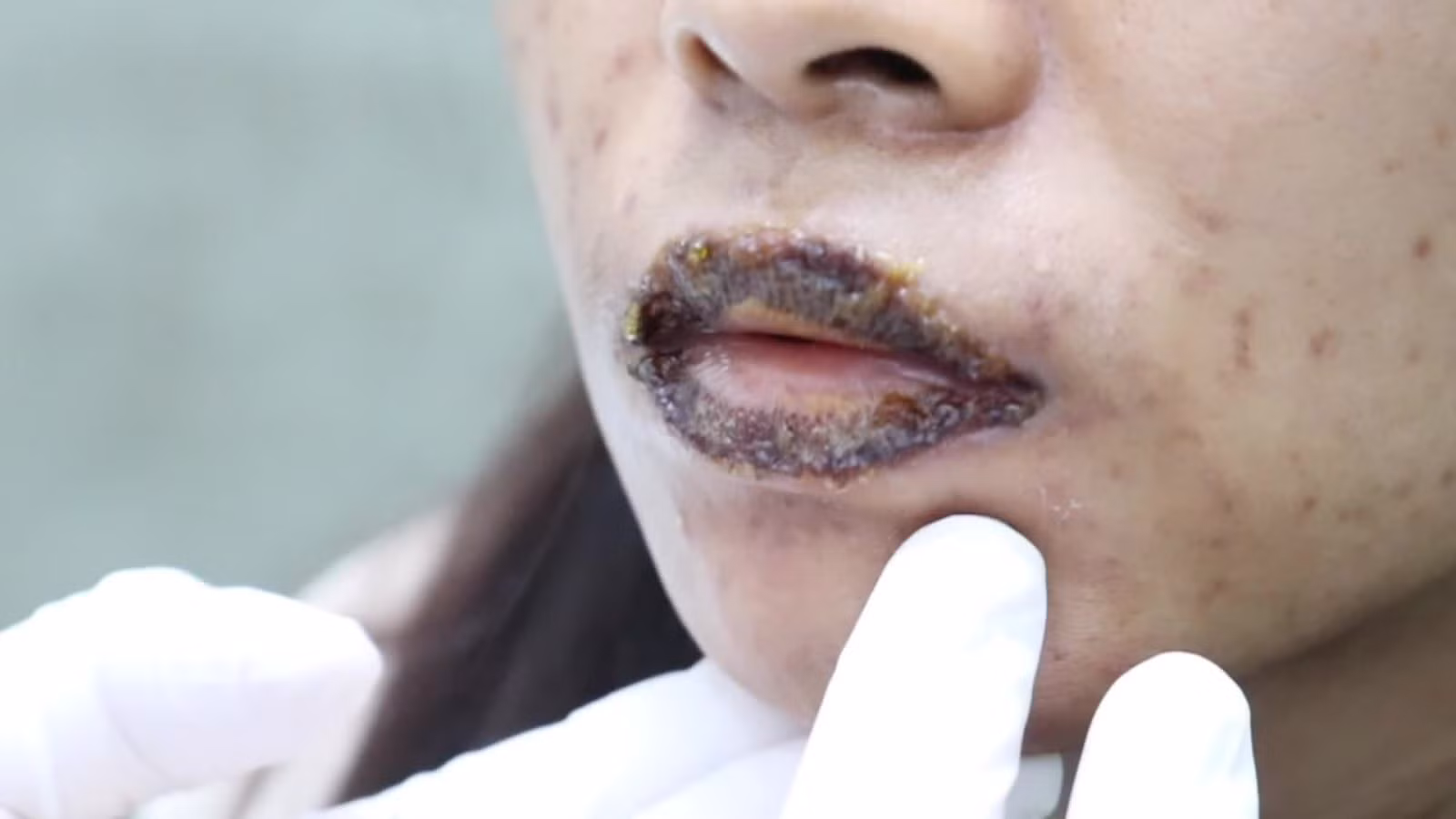 Môi bị bong tróc, nhiễm trùng vì tin vào quảng cáo dịch vụ khử thâm môi công nghệ plama trên mạng.