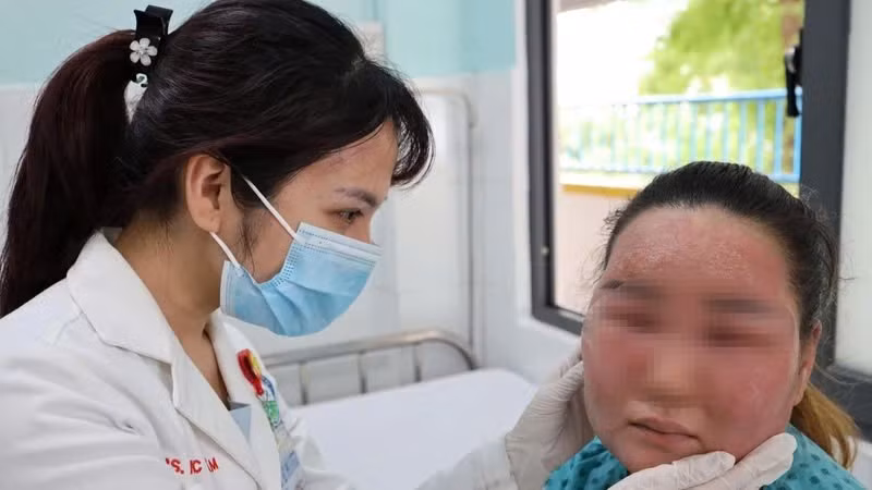 Một trường hợp biến chứng nặng trên da sau khi cùng sản phẩm peel da mua trên mạng.