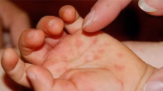 Gia tăng ca mắc tay chân miệng, Bộ Y tế yêu cầu tăng cường kiểm soát dịch