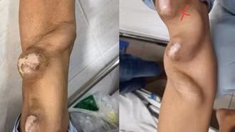 Cảnh báo suy thận ở người trẻ