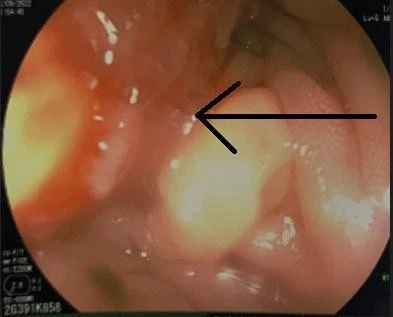 Phát hiện bệnh nhi 15 tuổi mắc ung thư đại tràng ảnh 1