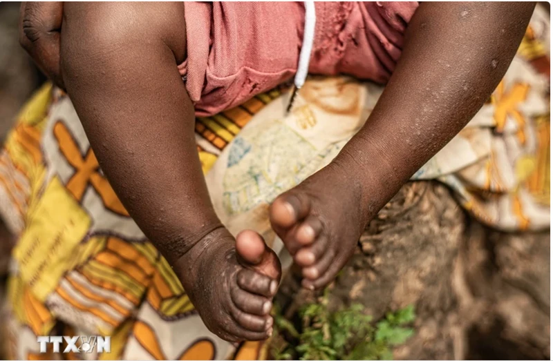 Em nhỏ mắc đậu mùa khỉ được điều trị tại Nyiragongo, Bắc Kivu, Cộng hòa Dân chủ Congo.