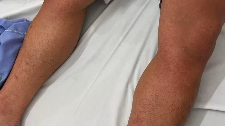 Bệnh nhân có chấm xuất huyết dưới da.