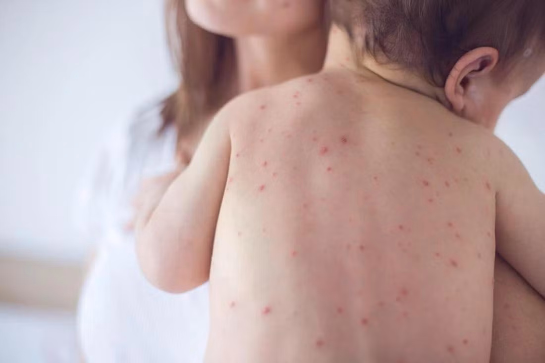 Nếu trong điều kiện không có biến chứng, các bậc phụ huynh có thể dễ dàng chăm sóc trẻ mắc sởi tại nhà.