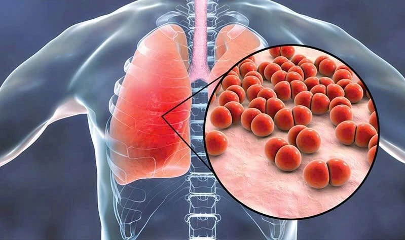 Nếu không phát hiện và điều trị kịp thời, cúm A có thể gây ra những biến chứng nặng.