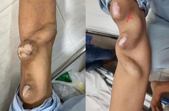Biến chứng mạch máu do chạy thận nhân tạo lâu năm.