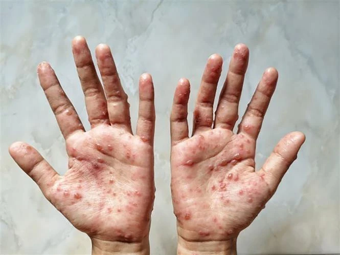 Các ban đỏ nổi trên tay một bệnh nhân mắc đậu mùa khỉ. Ảnh minh họa: Shutterstock/TTXVN